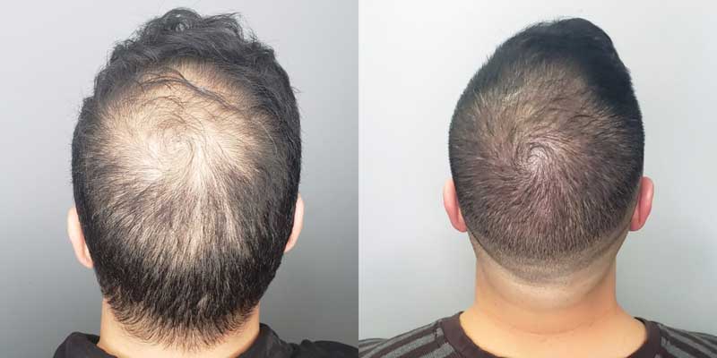تکنیک اسکالپ موی سر چیست و تا چه مدت ماندگاری دارد؟
